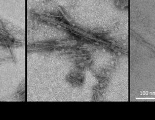 Transmission electron microscope image of three uncommon tau protein diseases.