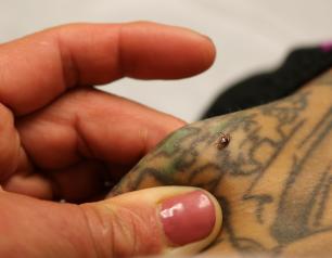 patient with tick bite