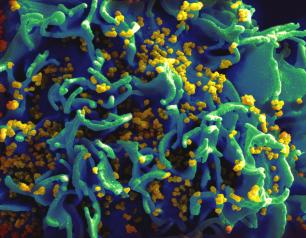 Scanning electron micrograph of a human H9 T cell infected with HIV virus particles.