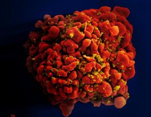 Scanning electron micrograph of an HIV-infected H9 T cell.