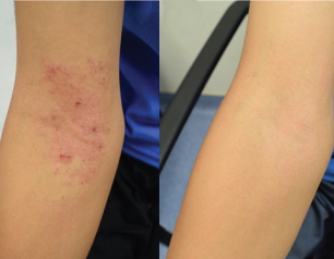 Left panel shows inner elbow covered with red rash and right panel shows inner elbow with clear skin