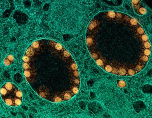 A transmission electron micrograph of SARS-CoV-2 virus particles (colored gold) within the endosomes of a heavily infected nasal olfactory epithelial cell. 