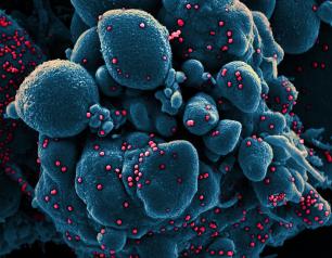 This image shows a colorized scanning electron micrograph of an apoptotic cell (blue) infected with SARS-COV-2 virus particles (red), isolated from a patient sample. The patient sample is not from the study described in this blog post. Image captured at the NIAID Integrated Research Facility in Fort Detrick, Maryland.