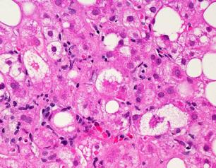 A microscopic image of liver tissue affected by non-alcoholic fatty liver disease (NAFLD)