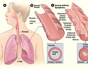 Illustration of key physiological differences between a normal lung airway and a lung airway in a person experiencing asthma symptoms. 