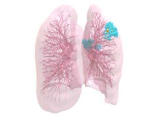 3D visualization of lungs and TB infection