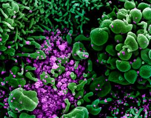 SEM of an apoptotic cell (green) heavily infected with SARS-COV-2 virus particles (purple)