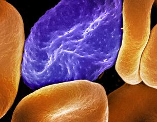 Colorized scanning electron micrograph of red blood cell infected with malaria parasites (purple). The small bumps on the infected cell show how the parasite remodels its host cell by forming protrusions called 'knobs' on the surface, enabling it to avoid destruction and cause inflammation. Uninfected cells (orange) have smoother surfaces.