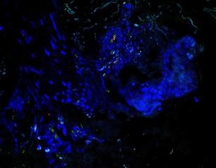 A lesional skin biopsy showing co-expression of the endothelial marker CD31 and the activation and adhesion marker, ICAM1 on Patient 1.