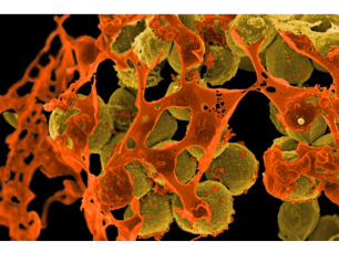 Scanning electron micrograph of methicillin-resistant Staphylococcus aureus (MRSA) in brown surrounded by cellular debris in orange.