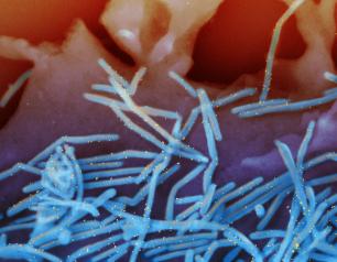 Colorized scanning electron micrograph of human respiratory syncytial virus (RSV) virions (blue) and labeled with anti-RSV F protein/gold antibodies (yellow) shedding from the surface of human lung epithelial cells.