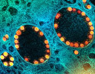 Transmission electron micrograph of SARS-CoV-2 virus particles (gold) within endosomes of a heavily infected nasal epithelial cell. 