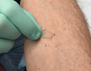 A researcher demonstrates the minimally invasive collection of skin samples using small, clear tape strips.