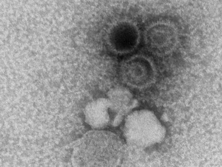 An electron microscopy image showing three Epstein-Barr virions.