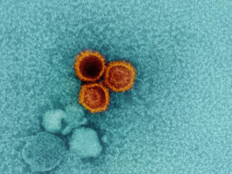 An electron micrographic shows a cluster of three round shapes, EBV virions, on top of a field of smaller specks