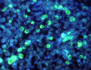 Primary Immune Deficiency Diseases (PIDDs)