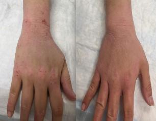Two photos of the same hand. On the left, the skin has a red rash. On the right, the skin does not.